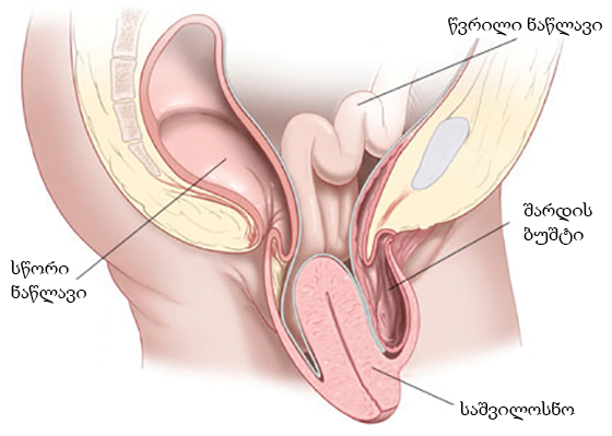 uterine-prolapse1